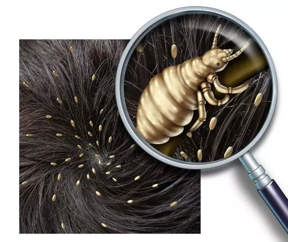 How to Get Rid of Lice Eggs in Hair Fast at Home?