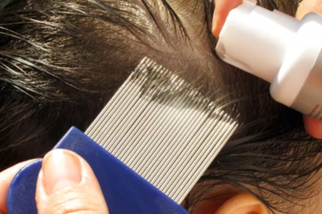 How to Remove Lice From Hair Permanently at Home?