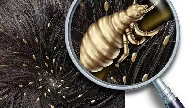 What Happens If Lice Go in Your Ear?