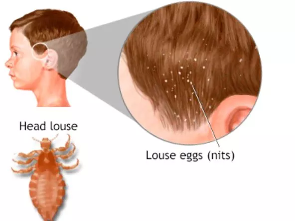 What Happens If Lice Go in Your Ear?