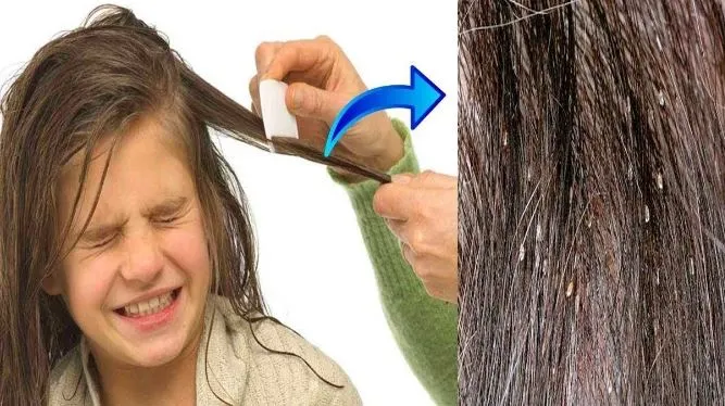How to Remove Nits From Hair Without the Use of a Comb?